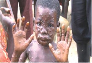 NCDC Declares Emergency as Monkeypox Claims First Life