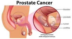 Microplastics Found in 90 Percent of Prostate Cancer Samples