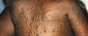 Monkeypox Case Found in US on Resident who Returned from Nigeria