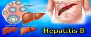 WHO Raises Alarm over Viral Hepatitis Causing 3,500 Deaths Daily